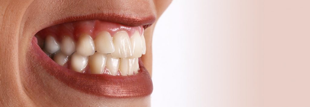 Zähneknirschen Bruxismus München